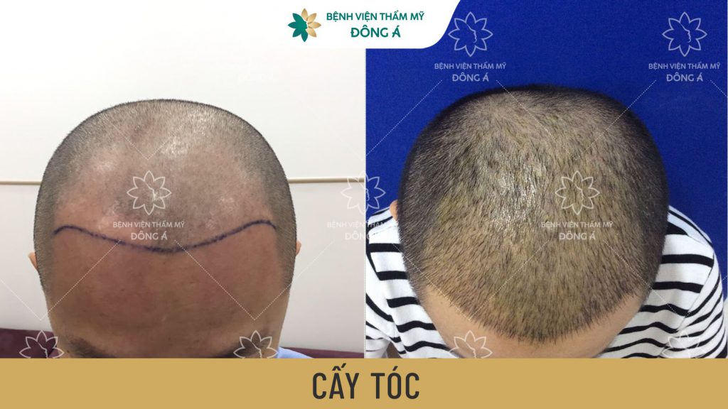 hình ảnh kh sau khi cấy tóc đẹp