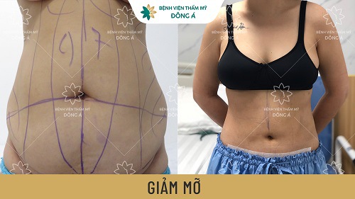 phương pháp giảm mỡ phân vùng slimlipo