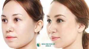 Phẫu thuật nâng gò má cho khuôn mặt hài hòa – Đẹp chuẩn từng cm