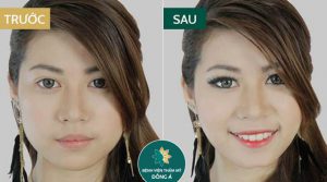 Phẫu thuật tạo cằm chẻ: An toàn cho khuôn mặt trẻ đẹp cân đối