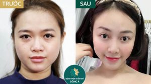 Lấy mỡ nọng cằm: Tan ngay bọng mỡ, gương mặt chuẩn V line