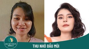 Thu nhỏ đầu mũi – Thon gọn, cân đối chuẩn tỉ lệ vàng