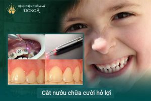 Bé cười hở lợi: Cách nhận biết và khắc phục sớm cho trẻ