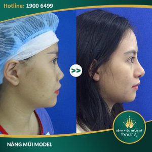 Bị sẹo lồi sau khi nâng mũi – Nguyên nhân & cách khắc phục hiệu quả