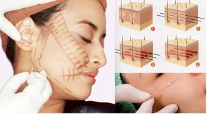 Căng da mặt bằng chỉ vàng giá bao nhiêu? Ở đâu Uy Tín và An Toàn?