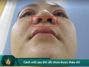 Cắt cánh mũi bị sẹo bao lâu thì hết? Có cách nào không để lại sẹo?