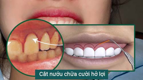Cắt nướu chữa cười hở lợi là giải pháp giúp bạn loại bỏ phần nướu thừa bằng dụng cụ cắt laser