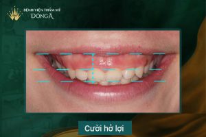 4 Cách chữa cười hở lợi tại nhà Đơn Giản – Hiệu Quả sau 5p
