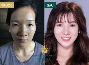 Chi phí độn cằm bao nhiêu tiền? Bảng giá độn cằm chuẩn nhất