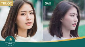 Độn cằm V line cho khuôn mặt thanh tú với dáng đẹp như ý