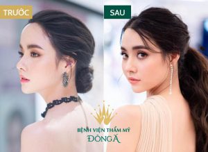 Gọt trán an toàn, giải pháp tạm biệt trán dô chỉ với 25 phút!