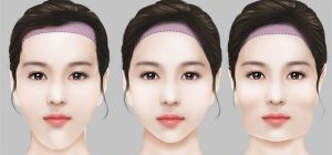 Hạ đường chân tóc | Phương pháp khắc phục trán cao, không để lại sẹo