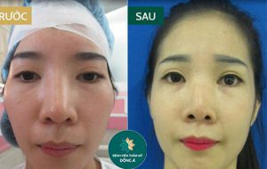 Phẫu thuật hạ gò má tại Đông Á – Kết quả, ưu điểm và chi phí thực hiện