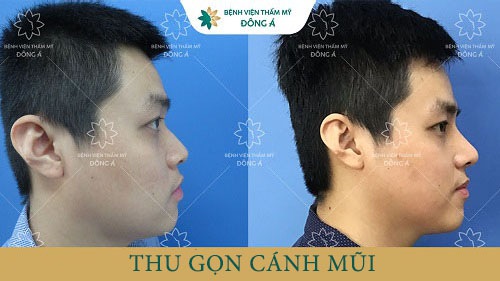Khách hàng thực hiện thu gọn cánh mũi tại Đông Á