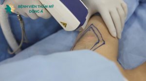Chi phí trị hôi nách bằng tia laser mới nhất ở Đông Á