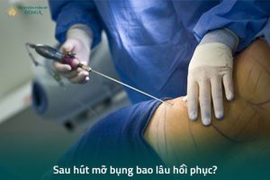 Hút mỡ bụng kiêng ăn gì? Hút mỡ bụng bao lâu hồi phục?