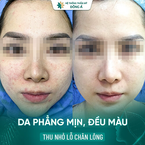 trị sẹo rỗ