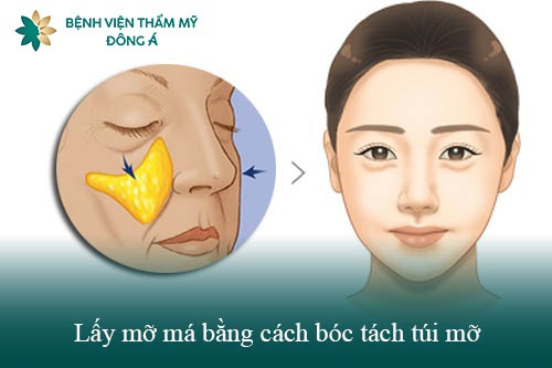 lấy mỡ má bằng cách bóc tách túi mỡ