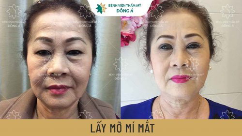 Đôi mắt trẻ trung, tươi mới sau khi lấy mỡ thừa