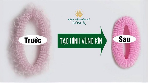 Thu nhỏ, tạo hình vùng kín được thực hiện như thế nào?