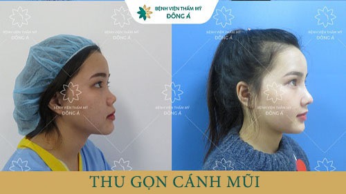 Khách hàng thực hiện thu gọn cánh mũi tại Đông Á
