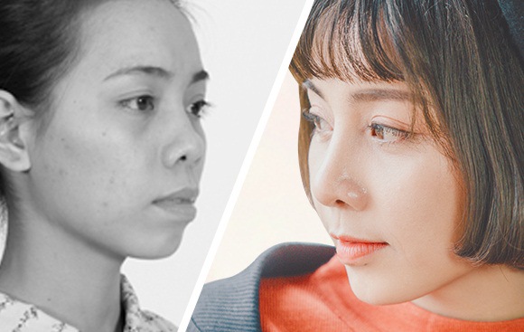 Thu gọn cánh mũi là gì?