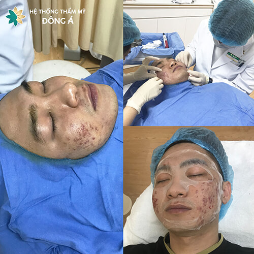 trị sẹo