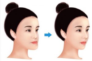 Phẫu thuật chỉnh hình xương hàm chỉ 1 lần cho khuôn mặt đẹp mãi