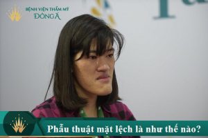 Phẫu thuật mặt lệch chi phí bao nhiêu tiền làm thế nào để dứt điểm