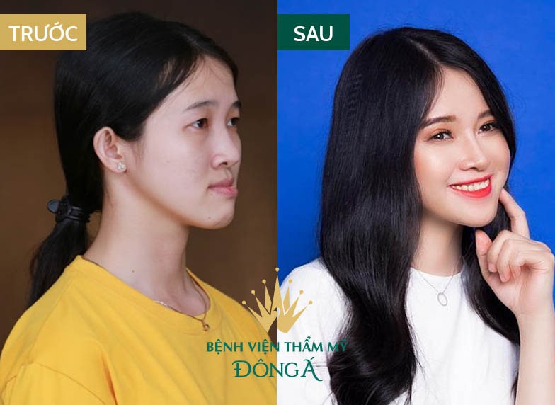 Phẫu thuật mặt lệch - Chữa dứt điểm khuôn mặt bất cân xứng 5