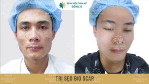 Điều trị sẹo Bio Scar – Giúp khắc phục mọi loại sẹo, trả lại làn da mịn màng