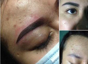 Phun lông mày bị lệch – Nguyên nhân và cách xử lý nhanh chóng, hiệu quả, an toàn nhất