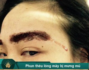 Phun lông mày bị mưng mủ – Nguyên nhân và cách xử lý hiệu quả, an toàn nhất