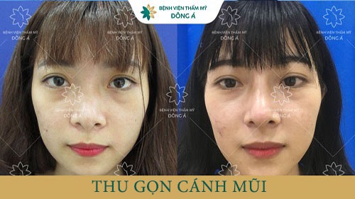 Khách hàng thực hiện thu gọn cánh mũi tại Đông Á