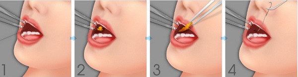 quy trình lấy mỡ má đông á