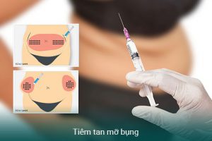 Tiêm tan mỡ bụng là gì? Chi phí tiêm tan mỡ bụng giá bao nhiêu?