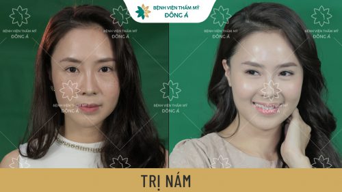 khách hàng điều trị nám