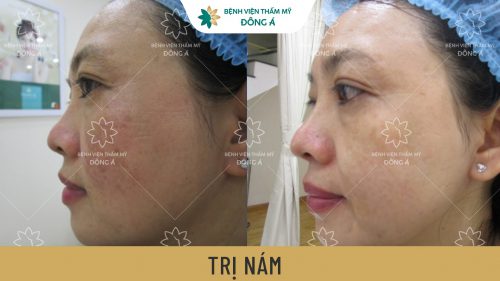 kết quả điều trị nám