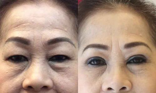 công nghệ xóa rãnh lệ