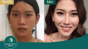 Gọt hàm V LINE: Cho khuôn mặt đẹp thanh tú – chuẩn tỷ lệ Vàng