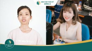 Phẫu thuật chỉnh hình hàm hô: Đem lại nụ cười tỏa nắng – an toàn – vĩnh viễn