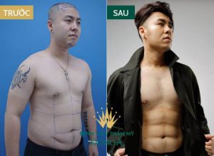 HÚT MỠ TOÀN THÂN KHÔNG PHẪU THUẬT – AN TOÀN, NHANH CHÓNG, HIỆU QUẢ