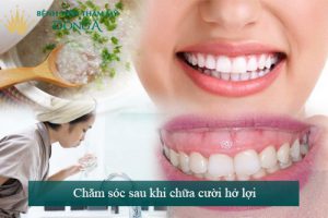 CHỮA CƯỜI HỞ LỢI BAO NHIÊU TIỀN? BẢNG GIÁ MỚI NHẤT 2019