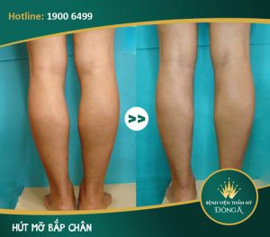 HÚT MỠ BẮP CHÂN GIÁ BAO NHIÊU TIỀN? CÁCH TIẾT KIỆM CHI PHÍ HIỆU QUẢ