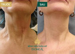 Căng da cổ ở đâu đẹp và uy tín? Bảng giá căng da ở Đông Á