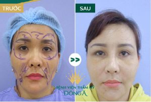 Căng da mặt nội soi ở đâu uy tín nhất Hà Nội & TP.HCM?