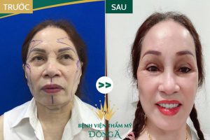 Căng da trán nội soi – 1 Lần duy nhất cho khuôn mặt Trẻ Đẹp