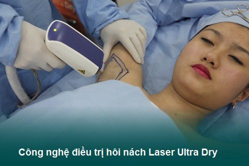 Công nghệ trị hôi nách laser ultra dry