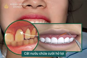 TƯỚNG SỐ PHỤ NỮ CƯỜI HỞ LỢI THÌ SAO, TỐT HAY XẤU, CÓ Ý NGHĨA GÌ?