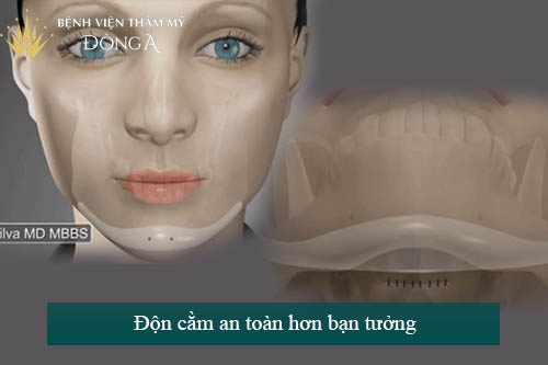 Độn cằm có nguy hiểm không & Lưu ý Quan Trọng cần biết 2